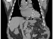 The CT scan’s “anatomic” assessment clearly demonstrates abnormal soft tissue within the chest, abdomen and pelvis of this patient presenting for post-chemotherapy evaluation. Unfortunately, simply knowing that abnormal soft tissue remains is not sufficient, for the CT does not indicate whether any or all of this tissue represents active malignancy or post-therapeutic scarring. For the activity of this soft tissue, we must rely on the PET portion of the exam. PET-Scan-fig-2-img-1
