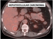 Figure 1 (Image 1) Hepatocellular carcinoma