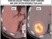 Figure 2 (Image 1) HCC