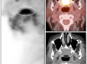 Figure 3 (Image 1) PET/CT Scan