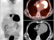 Figure 4 (Image 1) PET/CT Scan