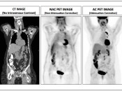Three sets of images generated during a PET/CT scan. The CT images (in three planes) provide anatomic detail. The PET images generated are “non-attenuation corrected” (NAC) images, which are of limited diagnostic value. Before the radiologist interprets the exam, the NAC images first undergo “attenuation–correction”, creating the AC images that will be used to interpret the PET/CT study. Attenuation correction and the value of AC & NAC images are addressed in greater detail). PET-Scan-fig-3-img-1