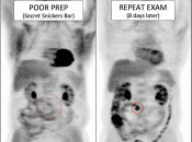 Figure 5 (Image 1) poor patient prep