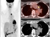 Figure 2 (Image 1) brown fat case 2