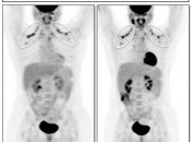 Figure 5 (Image 1) brown fat case 5