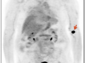 Figure 1 (Image 1) extravasation case 1