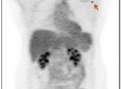 Figure 2 (Image 1) extravasation case 2