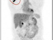 Figure 3 (Image 1) extravasation case 3