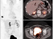 Figure 4 (Image 1) extravasation case 4