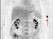 Figure 5 (Image 1) extravasation case 5