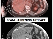 Figure 1 (Image 1) beam hardening artifact