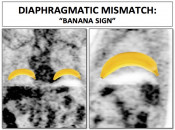 Figure 2 (Image 1) diaphragmatic mismatch