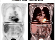 Figure 3 (Image 1) diaphragmatic mismatch