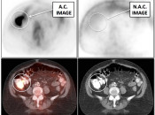 Figure 5 (Image 1) PET/CT Scan