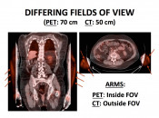 Figure 6 (Image 1) PET/CT Scan