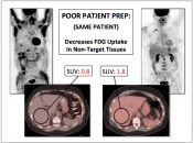 Figure 1 (Image 1) poor patient prep