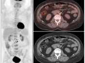 Figure 1 (Image 1) PET/CT Scan