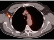 Figure 6 (Image 1) PET/CT Scan