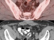 Figure 10 (Image 1) PET/CT Scan