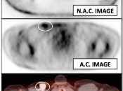 Figure 11 (Image 1) PET/CT Scan