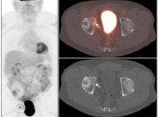Figure 2 (Image 1) PET/CT Scan