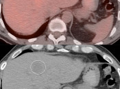 Figure 3 (Image 1) PET/CT Scan