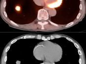 Figure 4 (Image 1) PET/CT Scan
