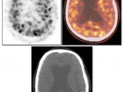 Figure 3 (Image 1) PET/CT Scan