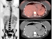 Figure 3 (Image 1) PET/CT Scan