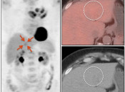 Case 2 (Image 1) PET/CT Scan