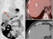 Case 3 (Image 1) PET/CT Scan