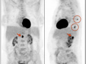 Case 6 (Image 1) PET/CT Scan