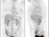 Case 7 (Image 1) PET/CT Scan