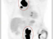 The PET portion of the exam demonstrates this soft tissue to be intensely FDG-avid, consistent with active malignancy. Stated more dramatically, the PET answers the pivotal question: “Does the patient have cancer or is the patient now cancer-free?” The limitation of the PET exam is that it cannot clearly give us the anatomic detail required to precisely indicate where all the sites of active disease are located. PET-Scan-fig-2-img-2