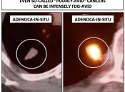 Figure 2 (Image 2) adenoca in situ