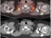 Figure 1 (Image 2) brown fat case 1
