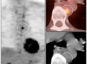 Figure 2 (Image 2) brown fat case 2