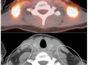 Figure 3 (Image 2) brown fat case 3