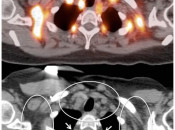 Figure 4 (Image 2) brown fat case 4