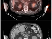Figure 1 (Image 2) extravasation case 1