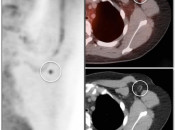 Figure 2 (Image 2) extravasation case 2