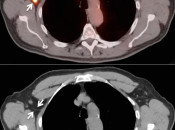 Figure 3 (Image 2) extravasation case 3