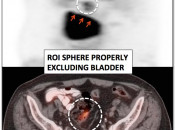 Figure 8 (Image 2) PET/CT Scan