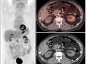 Figure 1 (Image 2) PET/CT Scan