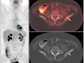 Figure 2 (Image 2) PET/CT Scan