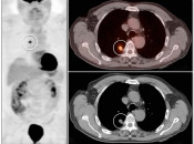 Figure 1 (Image 2) PET/CT Scan