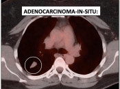 Figure 1 (Image 2) adenocarcinoma in situ