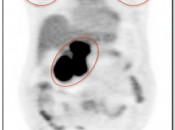 The PET portion of the exam serves a completely different function than the CT scan. It tells us whether the abnormal soft tissue seen on the CT scan represents active malignancy or post-therapeutic scar tissue. In this case, the intense metabolic activity is consistent with active lymphoma both above and below the diaphragm. PET-Scan-fig-1-img-2
