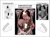 Again, the fused images demonstrate an elegant map of all active disease (the “anatomic” value of the CT scan combined with the “functional” value of the PET study). PET-Scan-fig-2-img-3