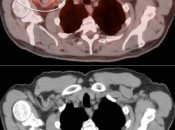 Figure 3 (Image 3) extravasation case 3